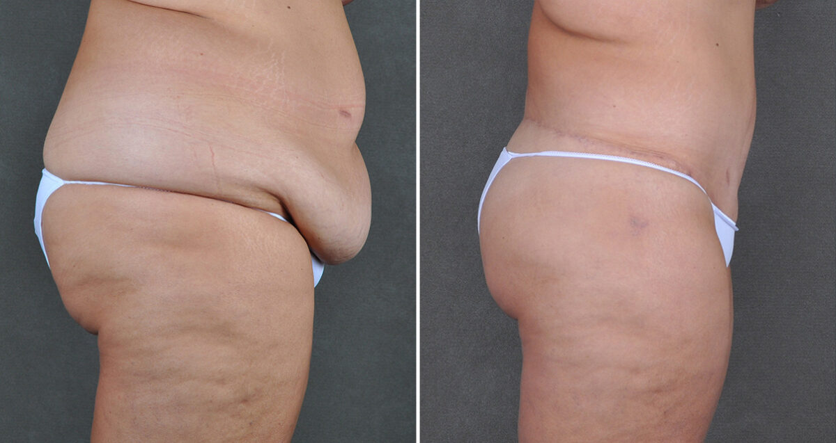 Case 22065, Tummy Tuck Before and After Photos Tummy Tuck Before and After Photos in Omaha, NE, Case 22065