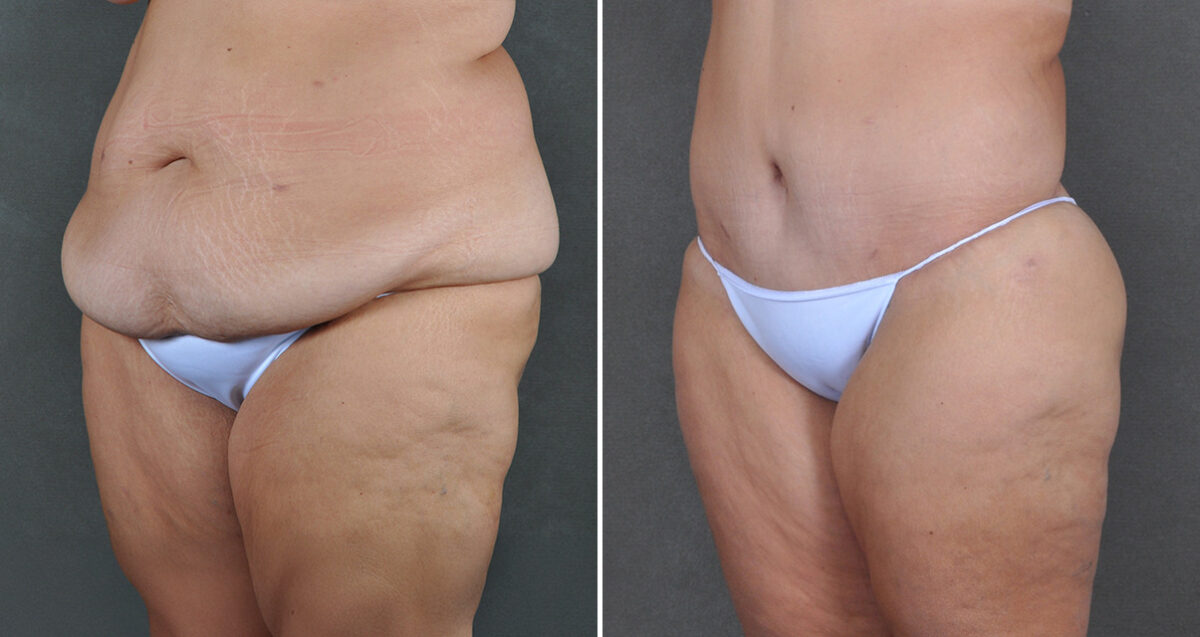 Case 22065, Tummy Tuck Before and After Photos Tummy Tuck Before and After Photos in Omaha, NE, Case 22065