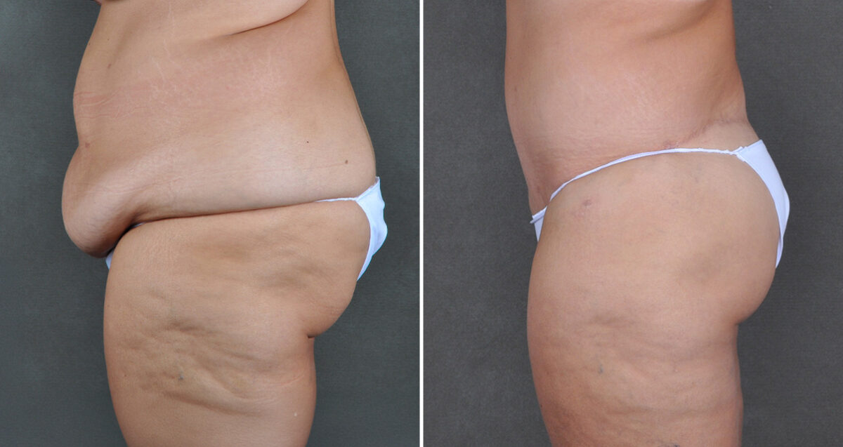 Case 22065, Tummy Tuck Before and After Photos Tummy Tuck Before and After Photos in Omaha, NE, Case 22065
