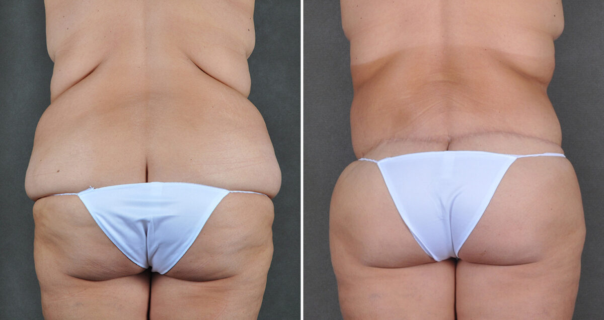 Case 22065, Tummy Tuck Before and After Photos Tummy Tuck Before and After Photos in Omaha, NE, Case 22065