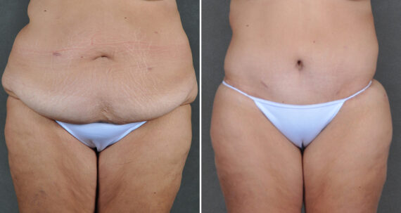 Tummy Tuck Before and After Photos in Omaha, NE, Case 22065