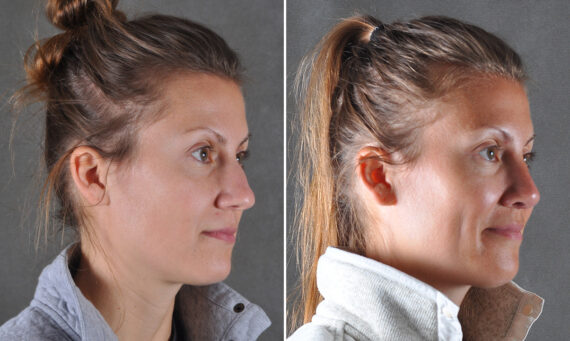 Rhinoplasty Before and After Photos in Omaha, NE, Case 22100