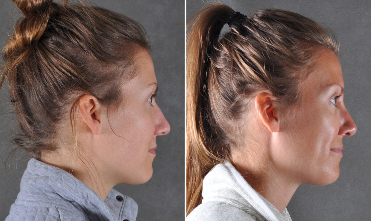 Case 22100, Rhinoplasty Before and After Photos Rhinoplasty Before and After Photos in Omaha, NE, Case 22100