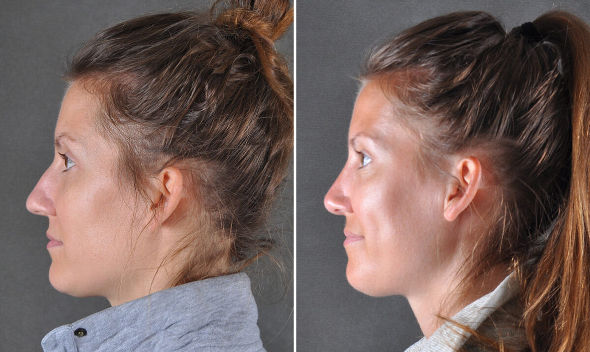 Case 22100, Rhinoplasty Before and After Photos Rhinoplasty Before and After Photos in Omaha, NE, Case 22100