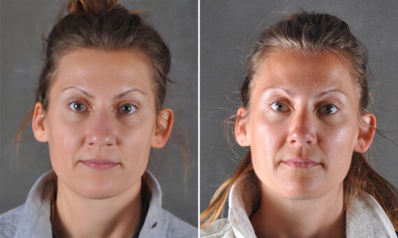 Rhinoplasty Before and After Photos in Omaha, NE, Case 22100