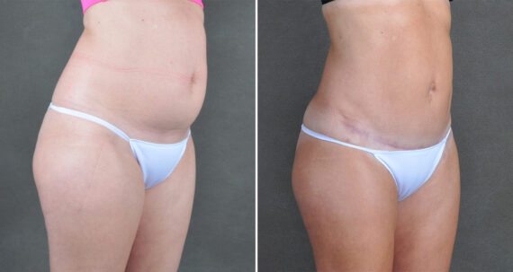 Liposuction Before and After Photos in Omaha, NE, Case 22124
