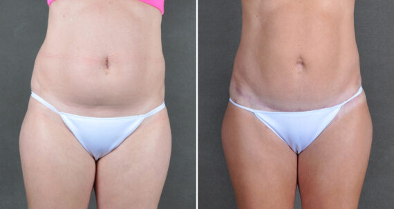 Liposuction Before and After Photos in Omaha, NE, Case 22124