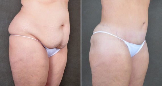 Liposuction Before and After Photos in Omaha, NE, Case 22160