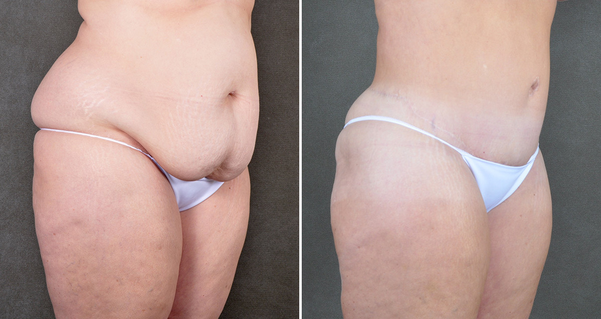 Tummy Tuck with Hernia Repair, Before and After Photos Liposuction Before and After Photos in Omaha, NE, Case 22160