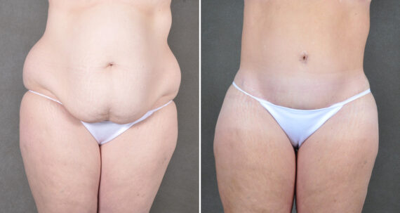 Liposuction Before and After Photos in Omaha, NE, Case 22160