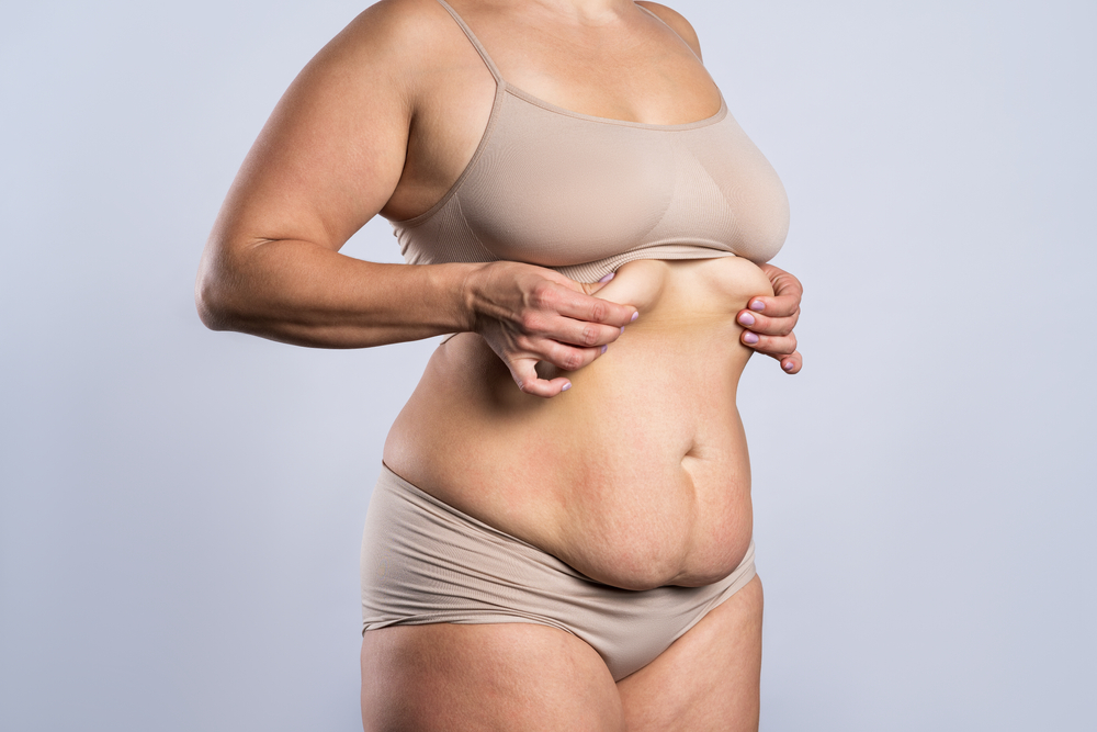 Woman with loose skin on upper and lower abdomen, a common condition treated by full tummy tuck surgery.