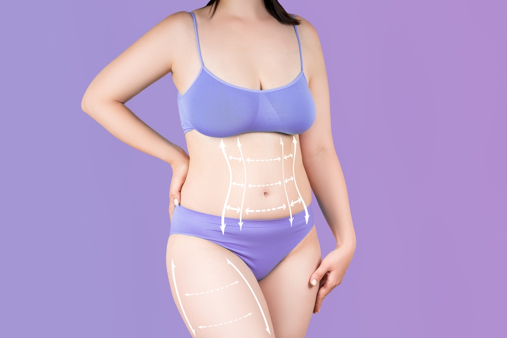 Woman in purple undergarments with contour lines indicating areas treated in a mini tummy tuck on lower abdomen.