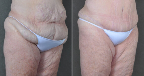 Liposuction Before and After Photos in Omaha, NE, Case 22871