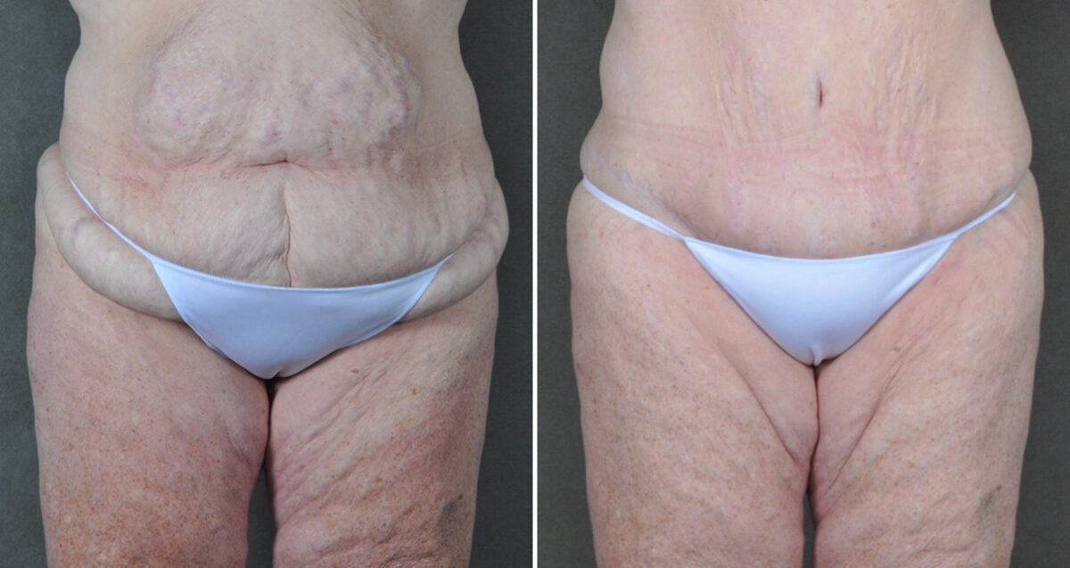 Liposuction Before and After Photos in Omaha, NE, Case 22871