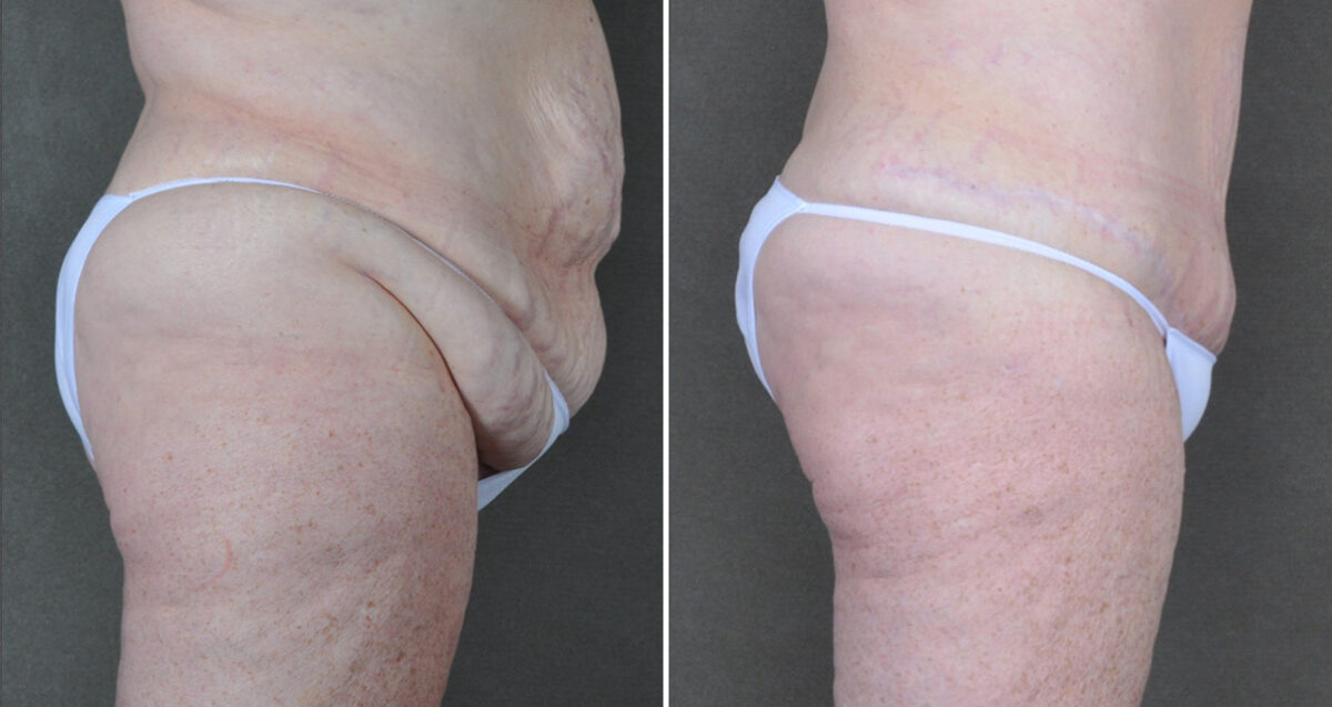 Liposuction Before and After Photos in Omaha, NE, Case 22871