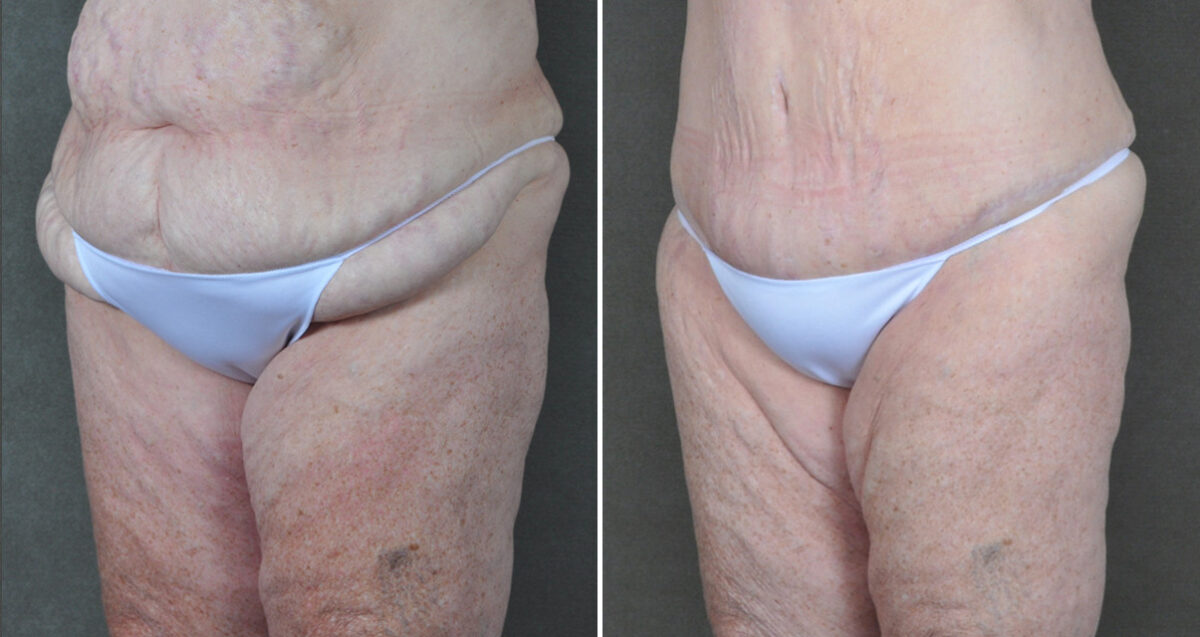 Liposuction Before and After Photos in Omaha, NE, Case 22871