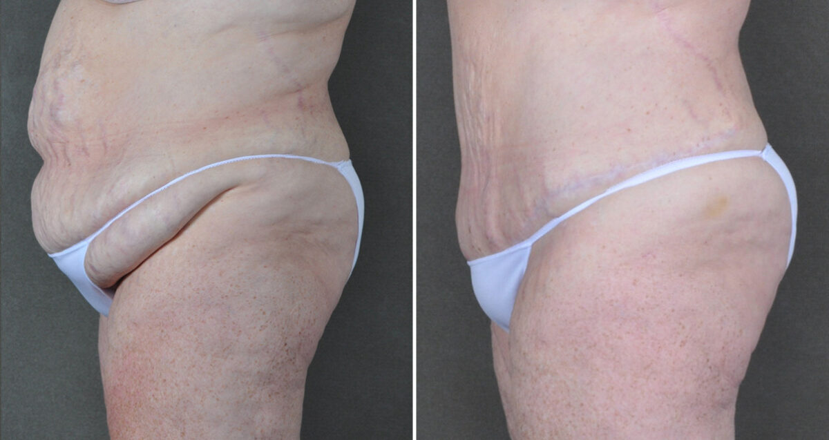 Liposuction Before and After Photos in Omaha, NE, Case 22871