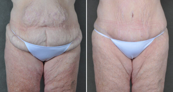 Liposuction Before and After Photos in Omaha, NE, Case 22871