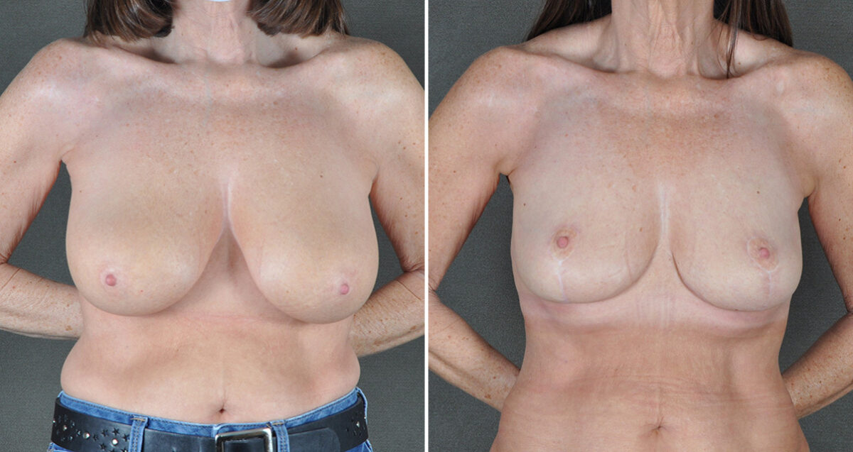 Case 22887, Breast Reduction Before and After Photos Breast Reduction Before and After Photos in Omaha, NE, Case 22887