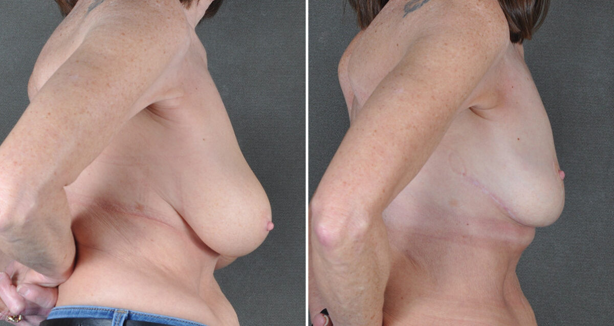 Case 22887, Breast Reduction Before and After Photos Breast Reduction Before and After Photos in Omaha, NE, Case 22887