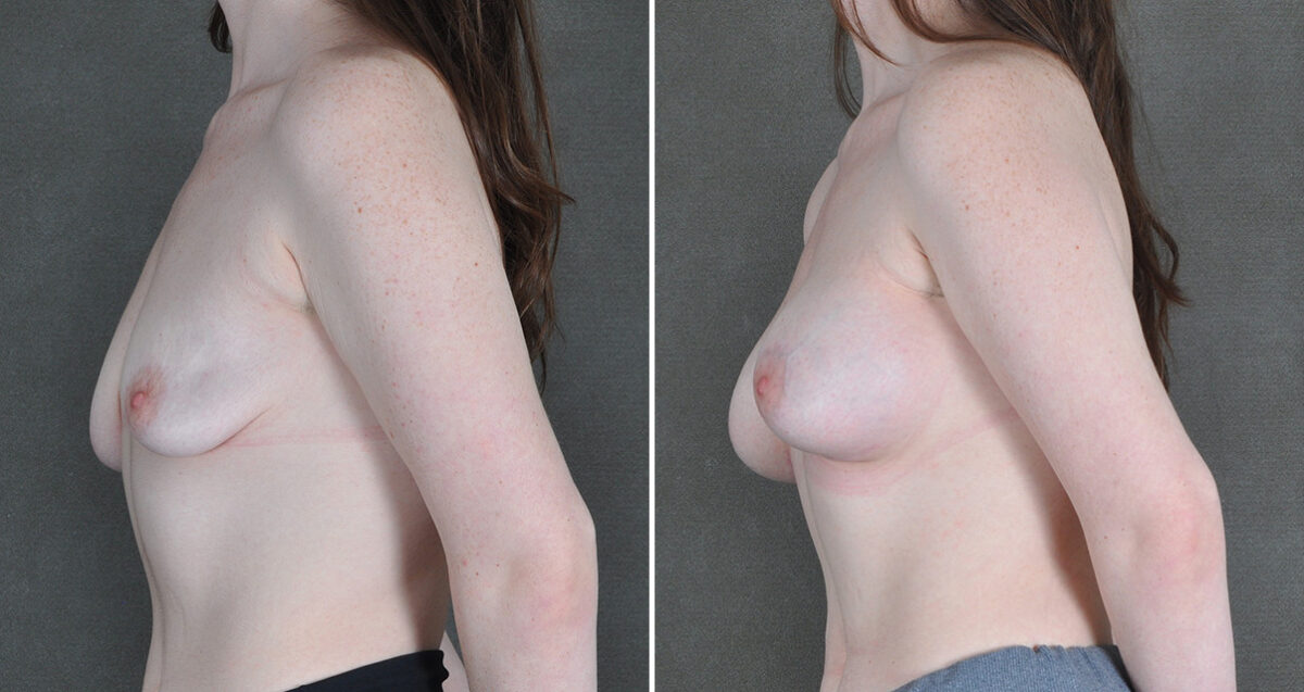 Breast Augmentation Before and After Photos in Omaha, NE, Case 22909