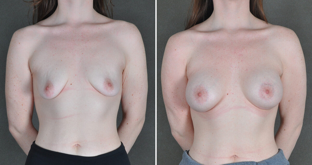 Breast Augmentation Before and After Photos in Omaha, NE, Case 22909