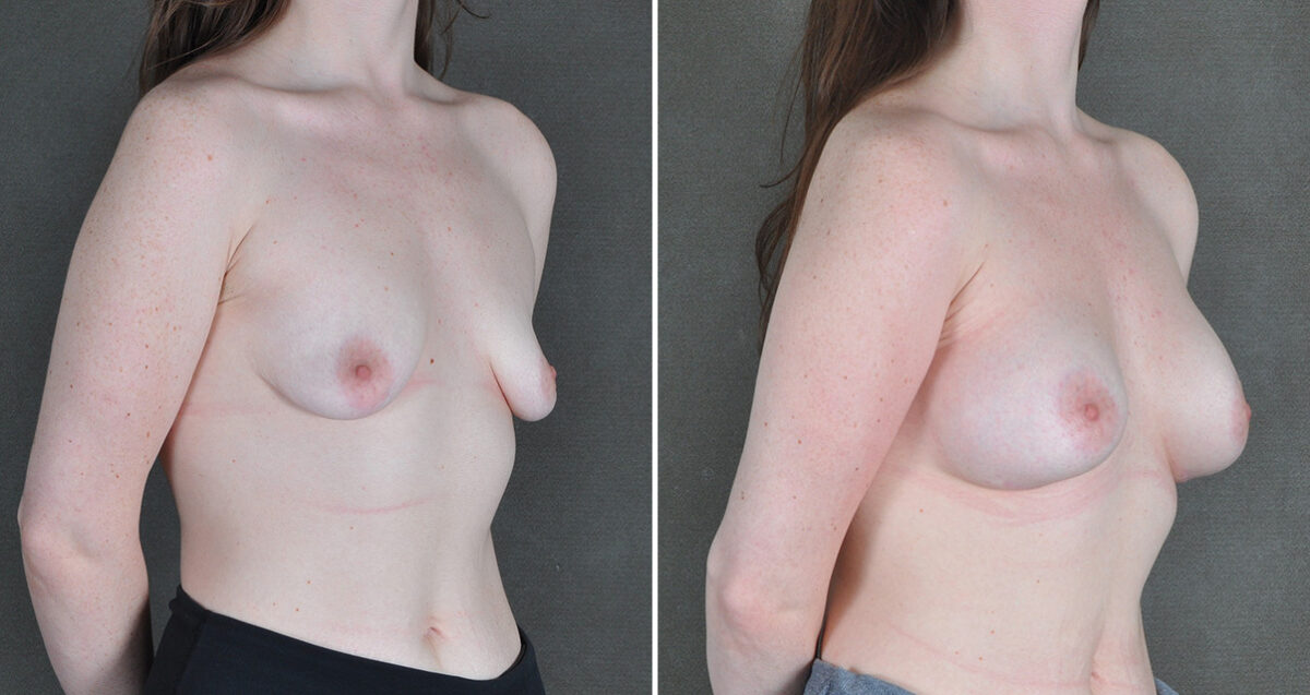 Breast Augmentation Before and After Photos in Omaha, NE, Case 22909