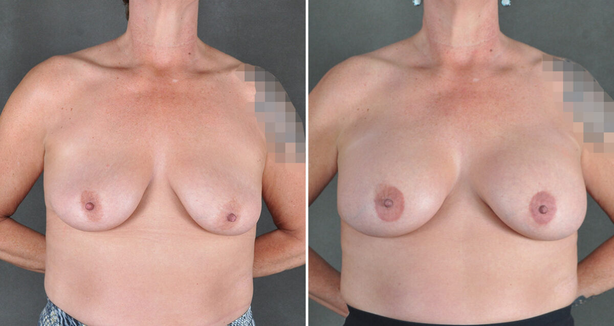 Breast Augmentation Before and After Photos in Omaha, NE, Case 22925