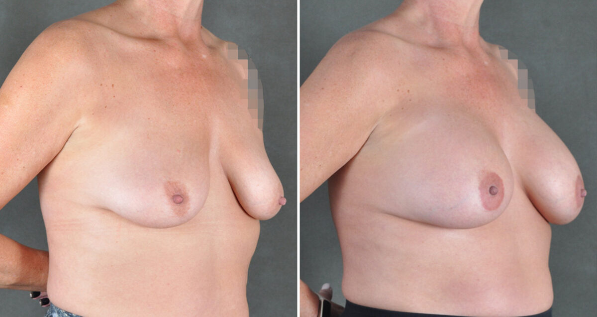 Breast Augmentation Before and After Photos in Omaha, NE, Case 22925