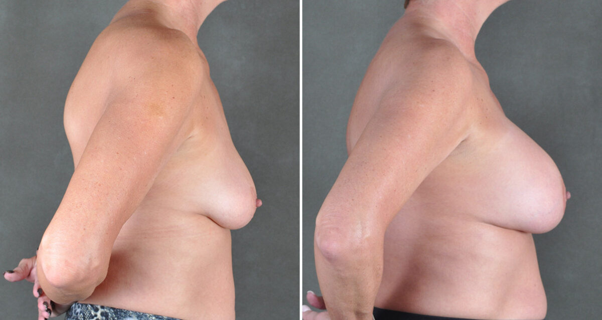 Breast Augmentation Before and After Photos in Omaha, NE, Case 22925