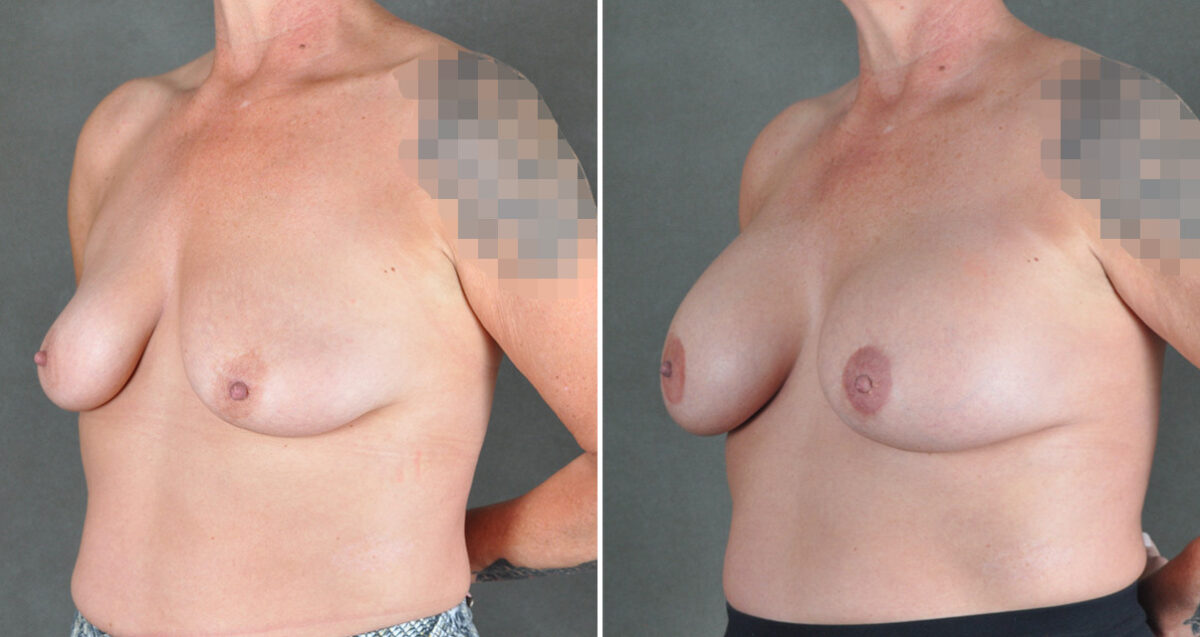 Breast Augmentation Before and After Photos in Omaha, NE, Case 22925
