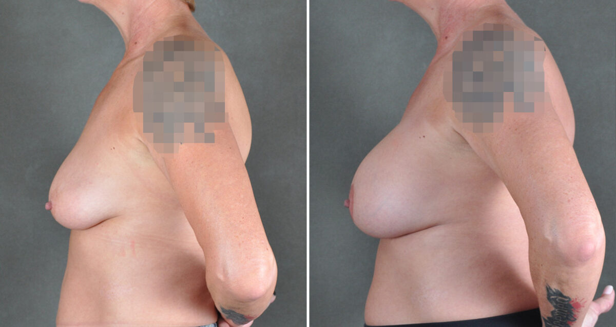 Breast Augmentation Before and After Photos in Omaha, NE, Case 22925