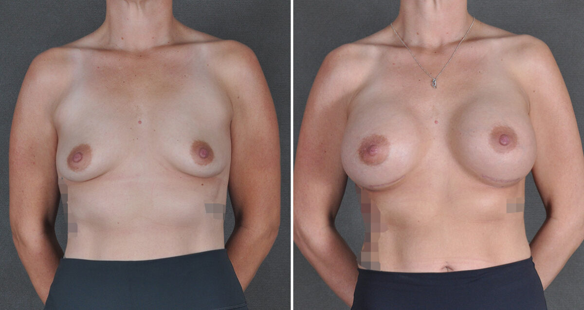 Breast Augmentation Before and After Photos in Omaha, NE, Case 22957