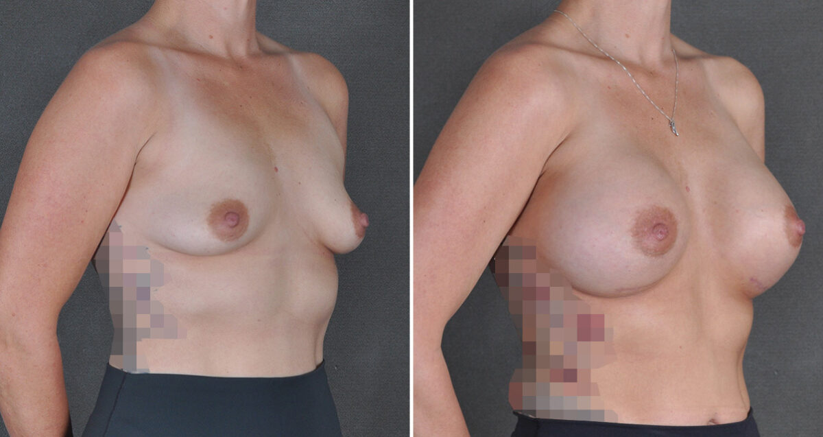 Breast Augmentation Before and After Photos in Omaha, NE, Case 22957