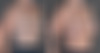 Breast Augmentation Before and After Photos in Omaha, NE, Case 22957