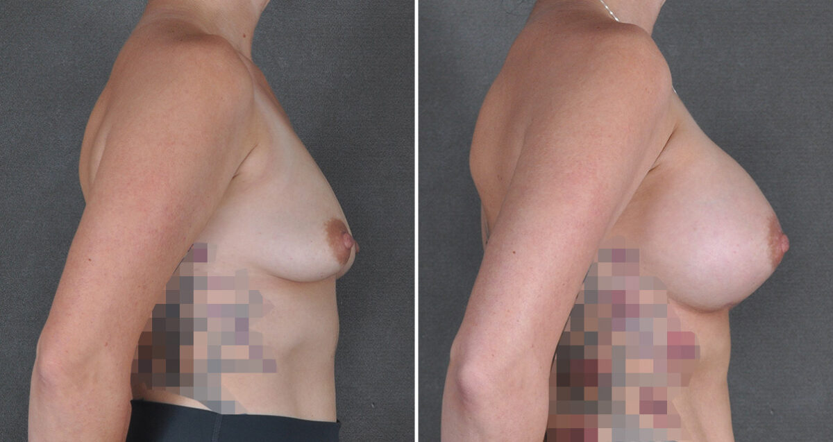 Breast Augmentation Before and After Photos in Omaha, NE, Case 22957