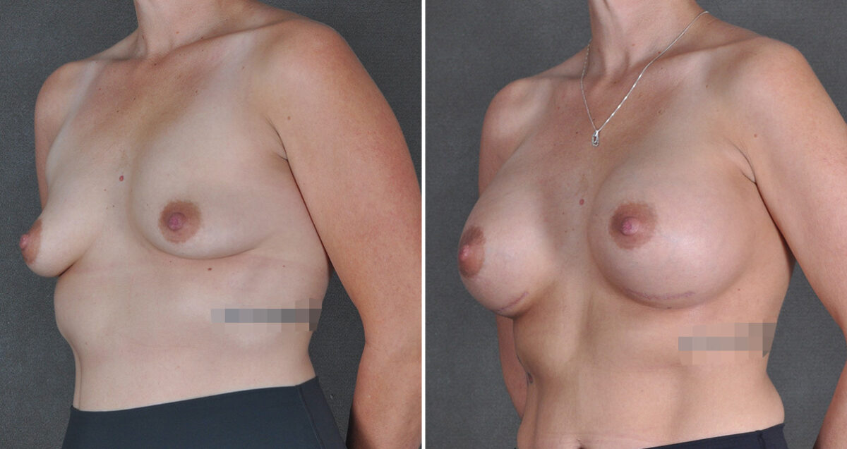 Breast Augmentation Before and After Photos in Omaha, NE, Case 22957
