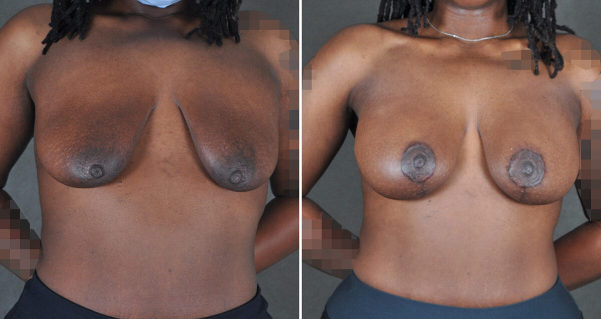 Breast Augmentation Before and After Photos in Omaha, NE, Case 22979