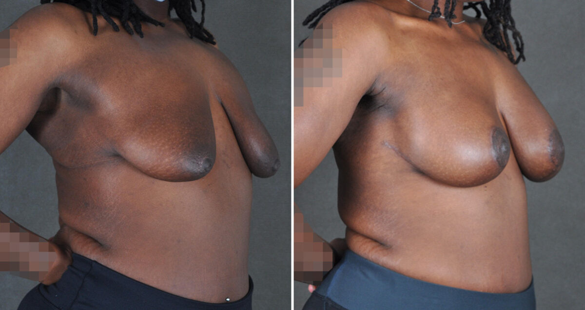 Breast Augmentation Before and After Photos in Omaha, NE, Case 22979