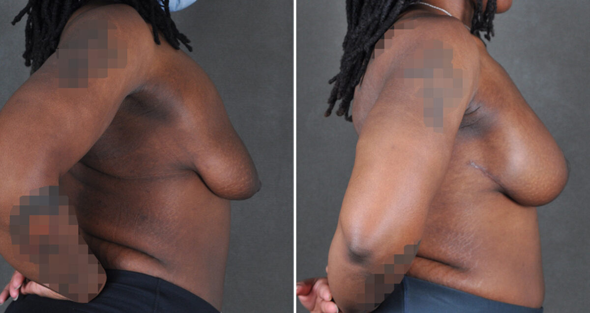 Breast Augmentation Before and After Photos in Omaha, NE, Case 22979