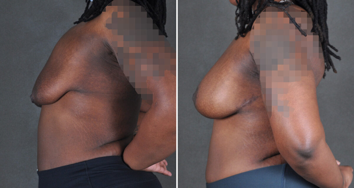 Breast Augmentation Before and After Photos in Omaha, NE, Case 22979