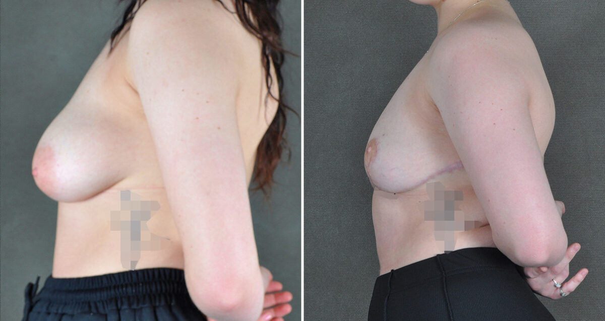 Case 23001, Breast Reduction Before and After Photos Breast Reduction Before and After Photos in Omaha, NE, Case 23001