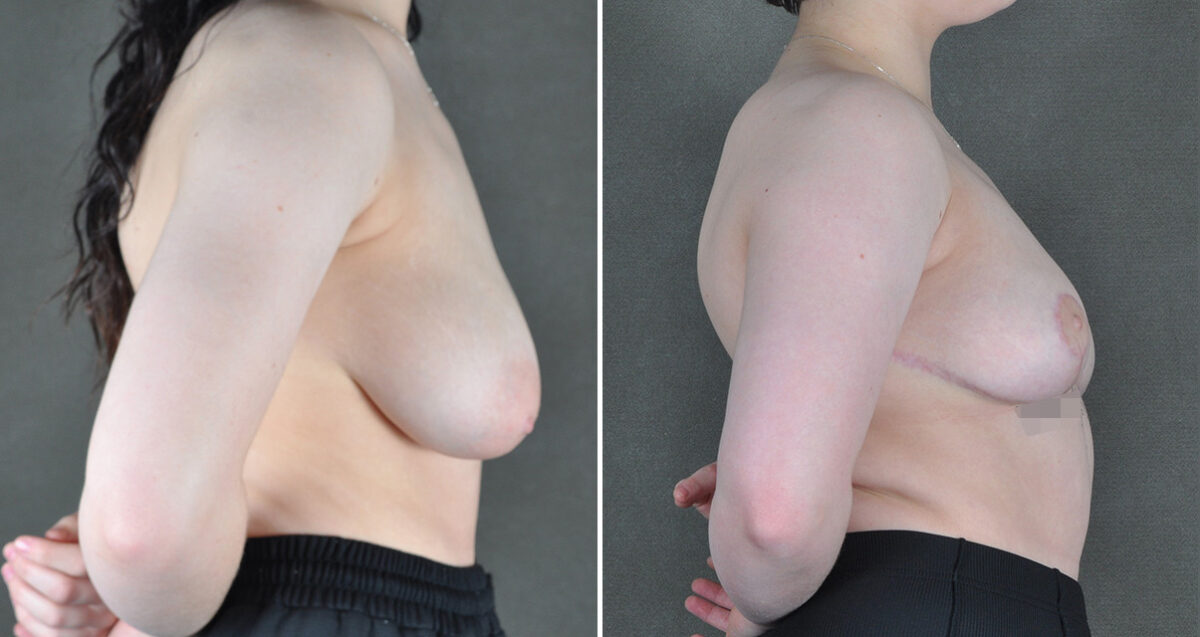 Case 23001, Breast Reduction Before and After Photos Breast Reduction Before and After Photos in Omaha, NE, Case 23001